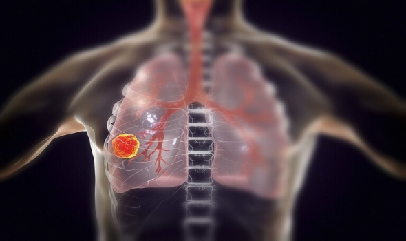 علماء يكشفون عن عوامل تسبب سرطان الرئة لغير المدخنين