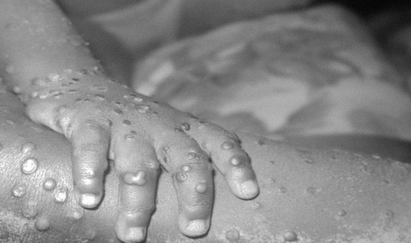 تفشي وباء الحصبة في إسرائيل مع تسجيل نحو 1880 إصابة منذ الربيع